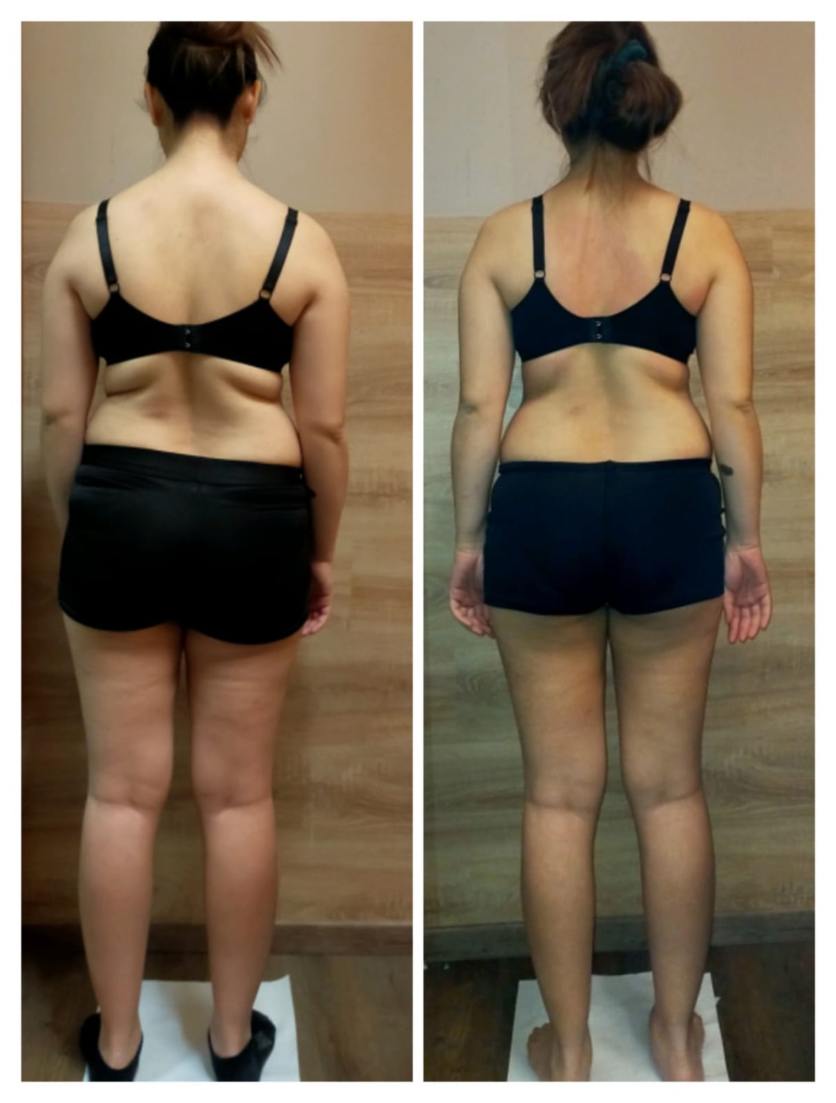 Confronto prima e dopo il trattamento osteoplastico