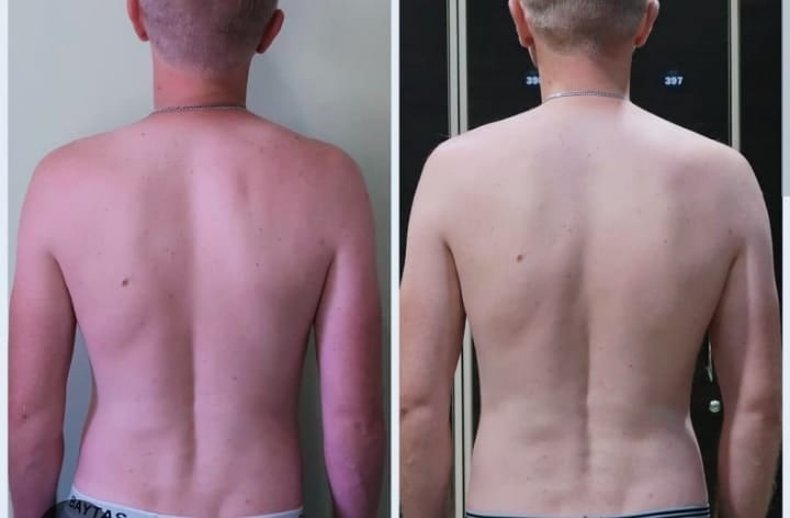 Confronto prima e dopo il trattamento osteoplastico