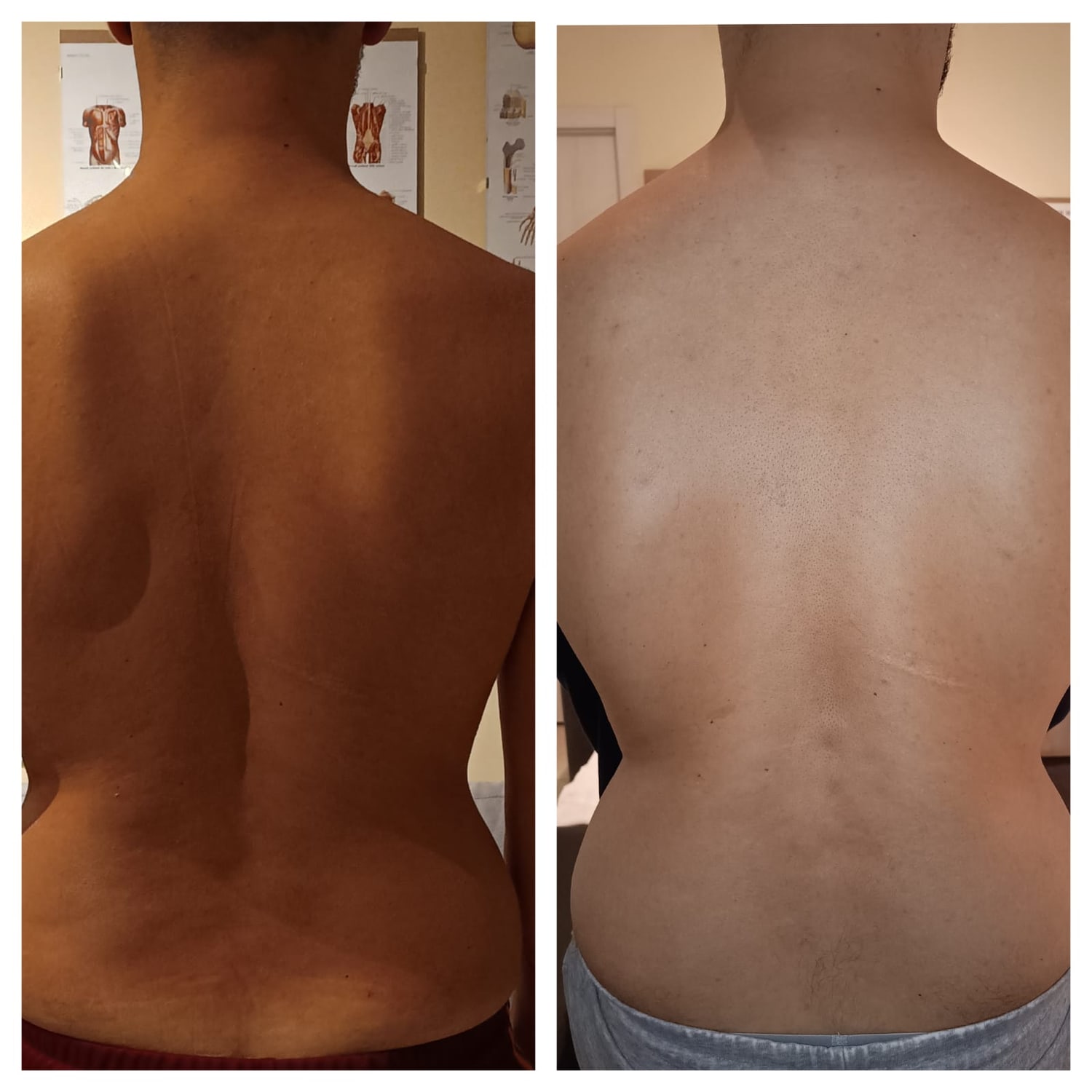 Confronto prima e dopo il trattamento osteoplastico