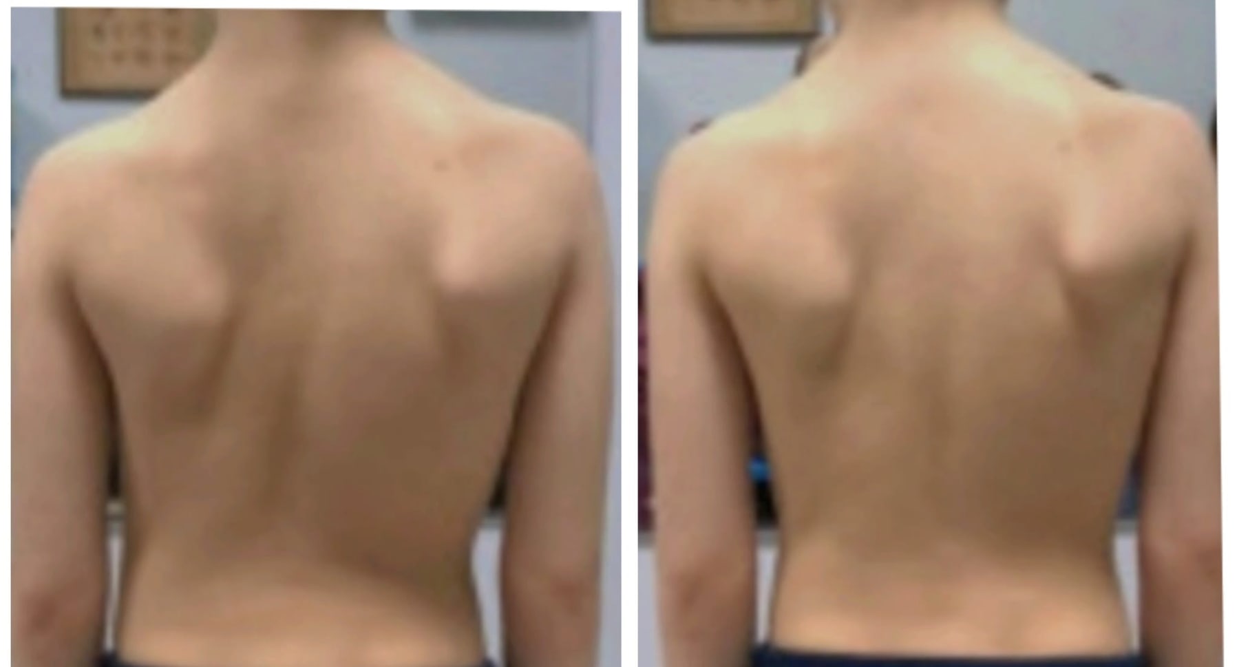 Confronto prima e dopo il trattamento osteoplastico