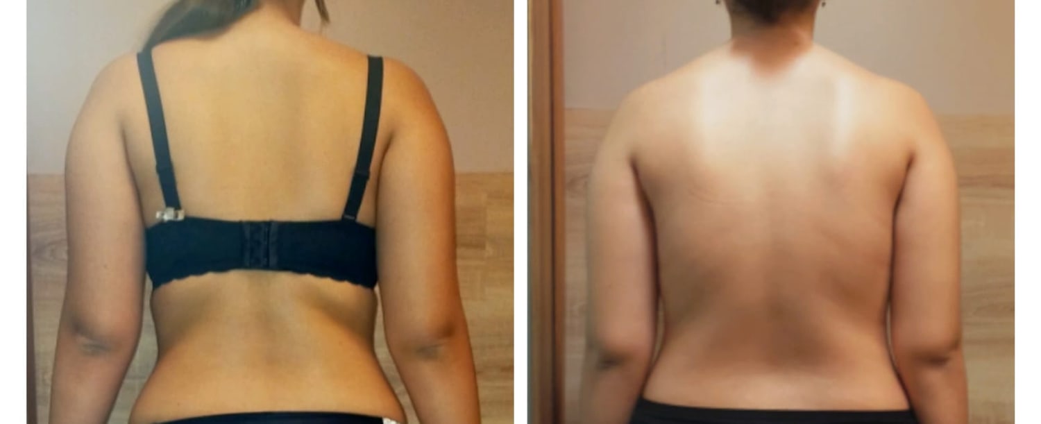 Confronto prima e dopo il trattamento osteoplastico