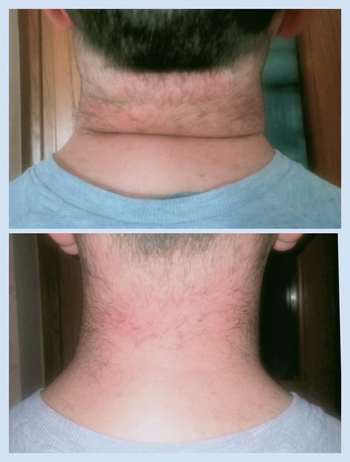 Confronto prima e dopo il trattamento osteoplastico